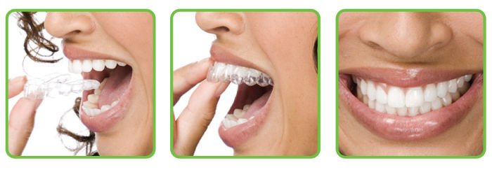 Clear Aligners Clear Correct Invisalign